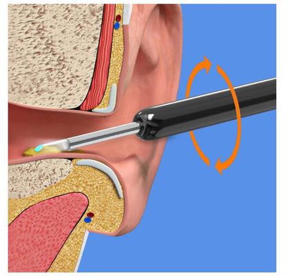 Earwax Removal Kit – Smart Visual Earwax Removal Tool